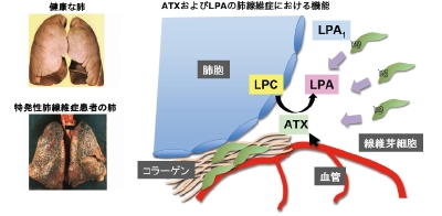 ATXと肺繊維症.jpg